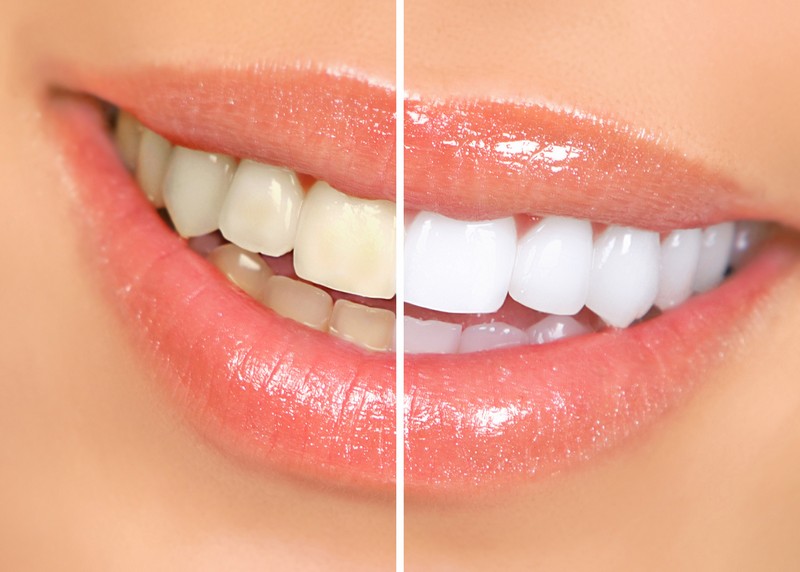 Teeth Whitening Phoenix, AZ