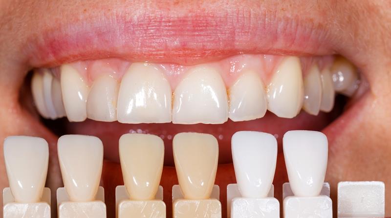 Veneers Phoenix, AZ
